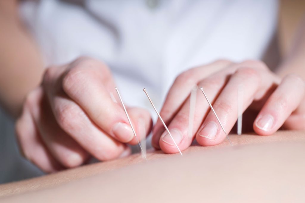 Acupuntura: Regulamentação e Benefícios de uma Prática Milenar