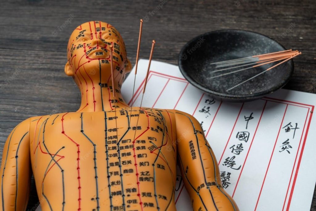 Acupuntura e a Riqueza da Medicina Tradicional Chinesa